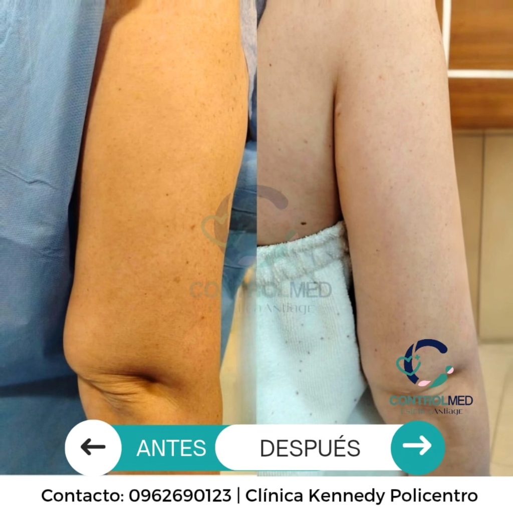 endobrazos