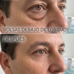 Blefaroplastia Inferior Quirúrgica