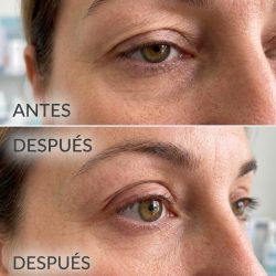 Blefaroplastia Superior Quirúrgico